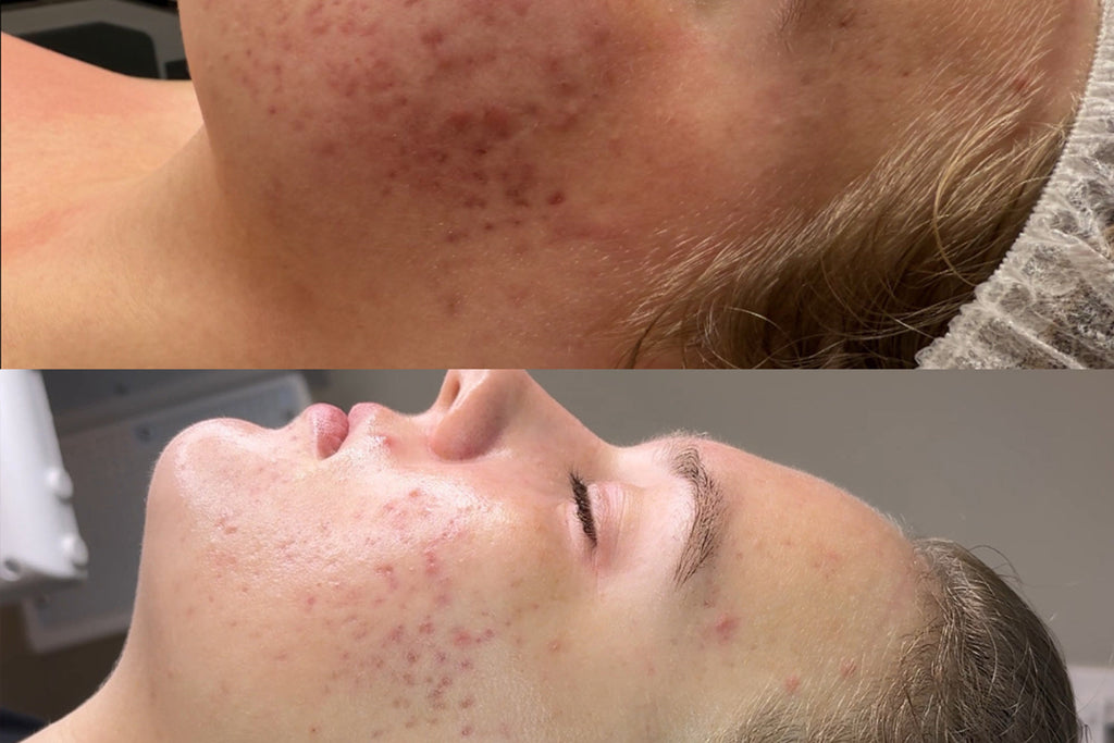 How to Prevent Sun Damage & Reverse Premature Aging with SQT Bio-Microneedling