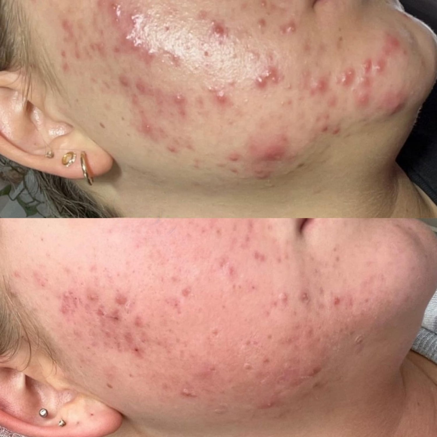 Breakouts, Acne and Acne Scarring