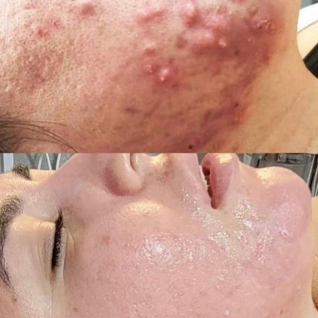 Benefits of SQT Bio-Microneedling