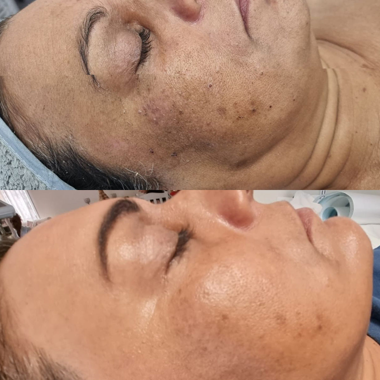 Pigmentation Treatment