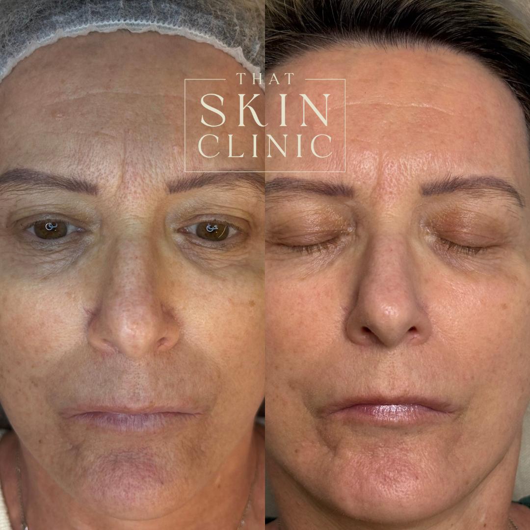 Benefits of Bio-Microneedling