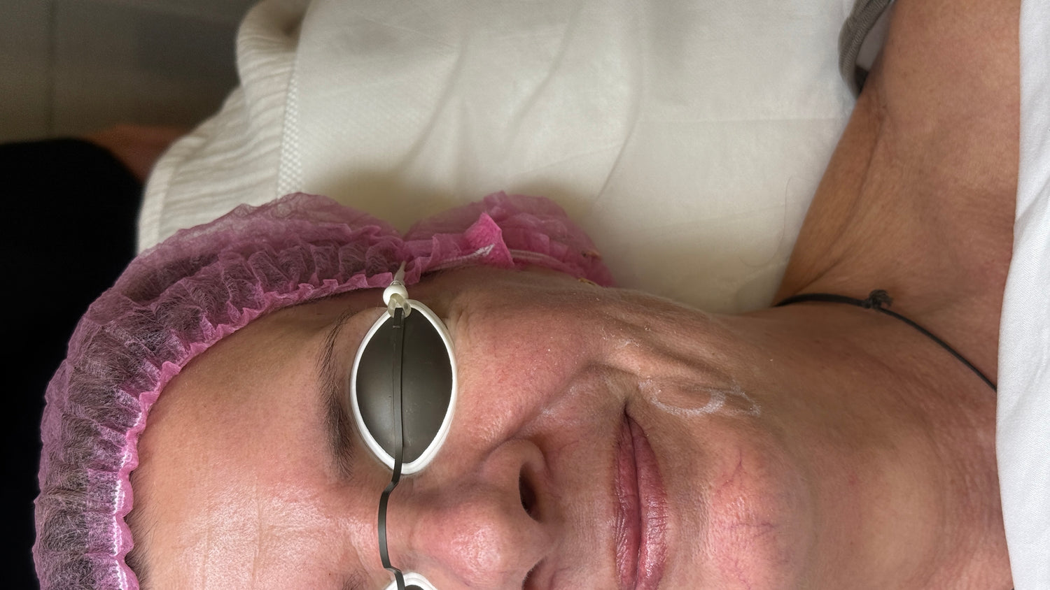 Laser Skin Resurfacing in Mooloolaba