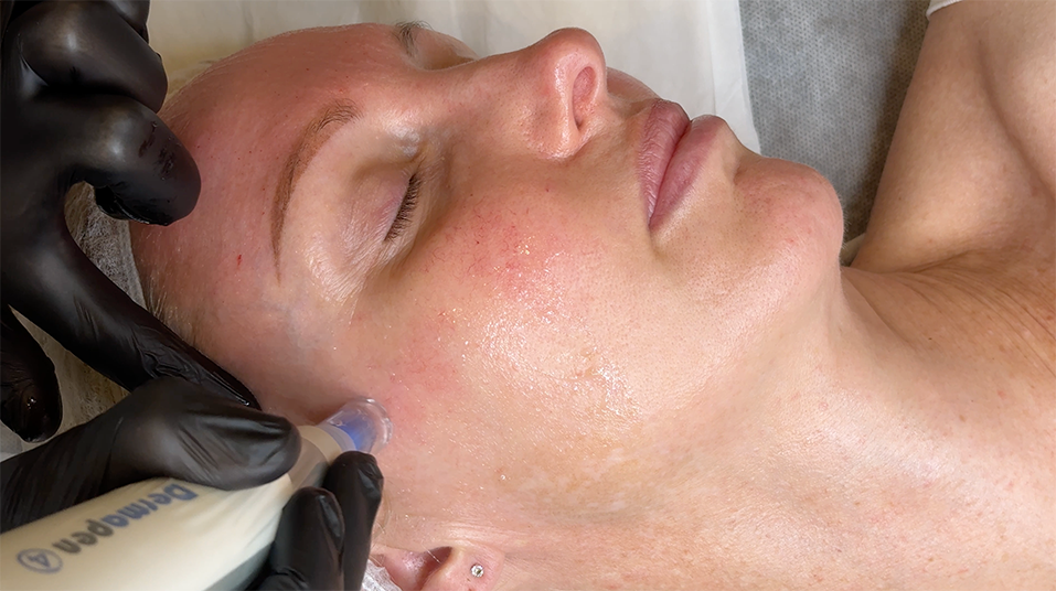 Skin Needling