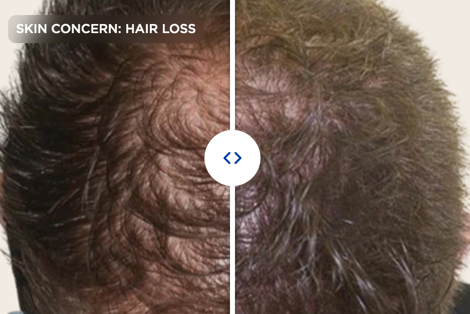 Struggling with thinning hair or hair loss?