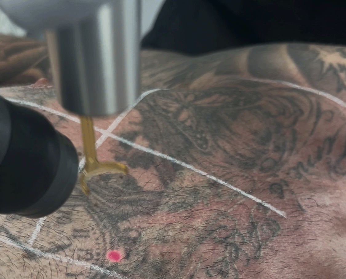 Benefits of Etherea MX HandPICO® Laser