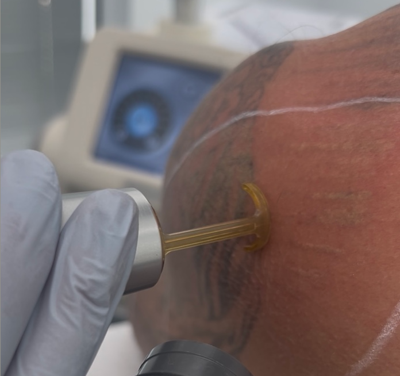 What's our Secret For Successful Tattoo Removal?