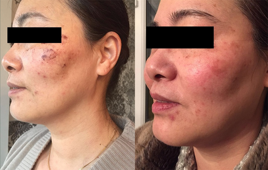 Pigmentation Mooloolaba