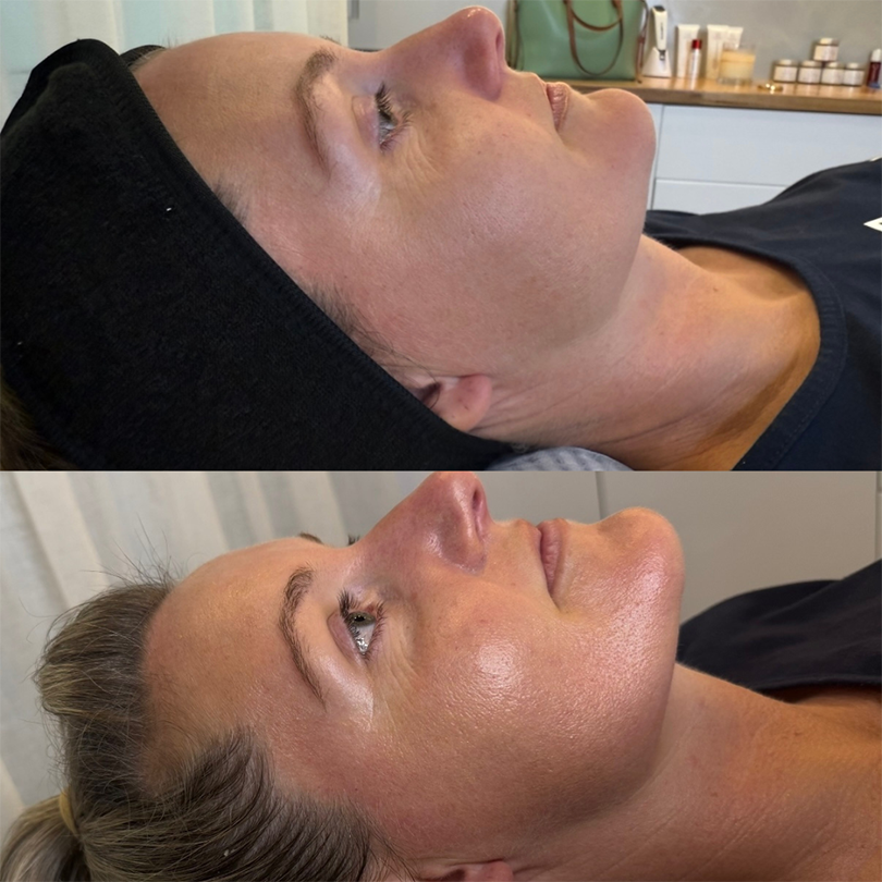 Medical Peels - Professional Skin Resurfacing